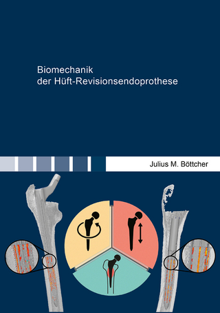 Biomechanik der Hüft-Revisionsendoprothese