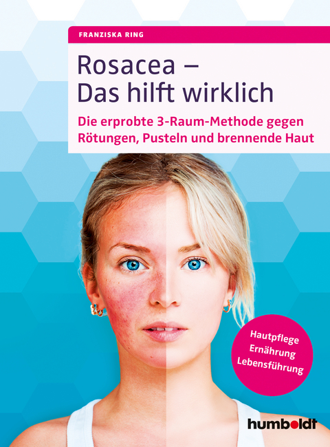 Rosacea &ndash; Das hilft wirklich - Franziska Ring