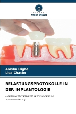 Belastungsprotokolle in Der Implantologie - Anisha Dighe, Lisa Chacko