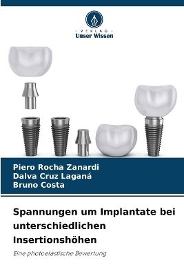 Spannungen um Implantate bei unterschiedlichen Insertionsh&ouml;hen - Piero Rocha Zanardi, Dalva Cruz Lagan&aacute;, Bruno Costa