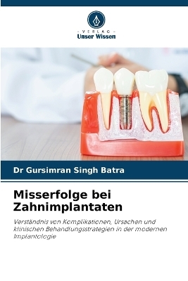 Misserfolge bei Zahnimplantaten - Dr Gursimran Singh Batra