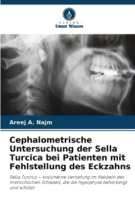 Cephalometrische Untersuchung der Sella Turcica bei Patienten mit Fehlstellung des Eckzahns