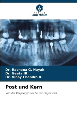 Post und Kern - Dr Rachana G Nayak, Dr Geeta Ib, Dr Vinay Chandra R