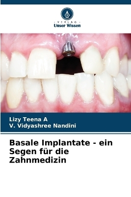 Basale Implantate - ein Segen f&uuml;r die Zahnmedizin - Lizy Teena A, V Vidyashree Nandini