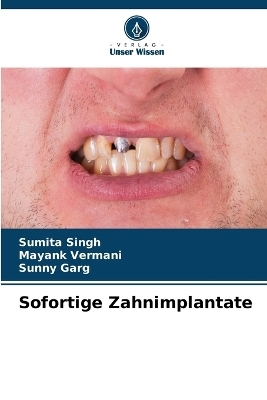Sofortige Zahnimplantate - Sumita Singh, Mayank Vermani, Sunny Garg