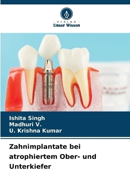 Zahnimplantate bei atrophiertem Ober- und Unterkiefer - Ishita Singh, Madhuri V, U Krishna Kumar