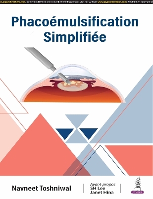 Phacoémulsification Simplifiée