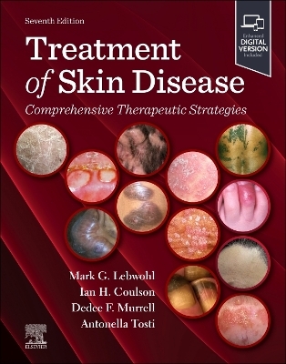 Treatment of Skin Disease: Comprehensive Therapeutic Strategies - 