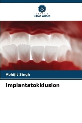 Implantatokklusion - Abhijit Singh