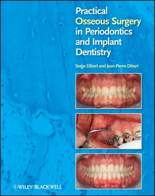 Practical Osseous Surgery in Periodontics and Implant Dentistry