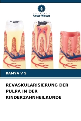 Revaskularisierung Der Pulpa in Der Kinderzahnheilkunde - RAMYA V S