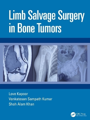 Limb Salvage Surgery in Bone Tumors - Love Kapoor, Venkatesan Sampath Kumar, Shah Alam Khan