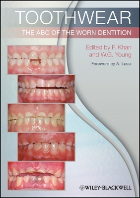 Toothwear – The ABC of the Worn Dentition