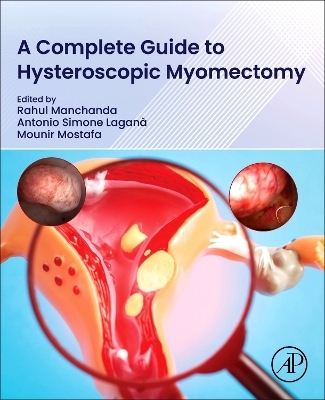 A Complete Guide to Hysteroscopic Myomectomy - 