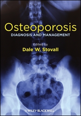 Osteoporosis – Diagnosis and Management