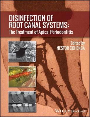 Disinfection of Root Canal Systems – The Treatment of Apical Periodontitis