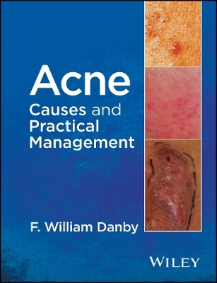 Acne – Causes and Practical Management