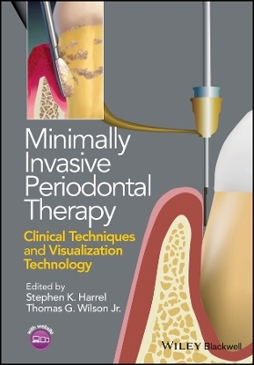 Minimally Invasive Periodontal Therapy: Clinical T echniques and Visualization Technology