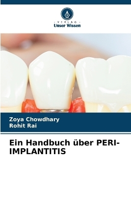 Ein Handbuch &uuml;ber PERI-IMPLANTITIS - Zoya Chowdhary, Rohit Rai