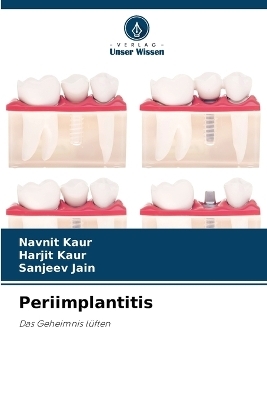 Periimplantitis - Navnit Kaur, Harjit Kaur, Sanjeev Jain