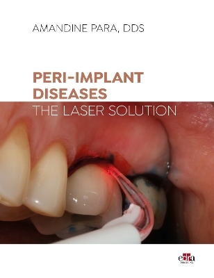 Peri-implant Diseases: The Laser Solution - Amandine Para