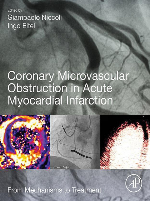 Coronary Microvascular Obstruction in Acute Myocardial Infarction - 