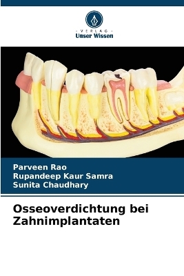 Osseoverdichtung bei Zahnimplantaten - Parveen Rao, Rupandeep Kaur Samra, Sunita Chaudhary