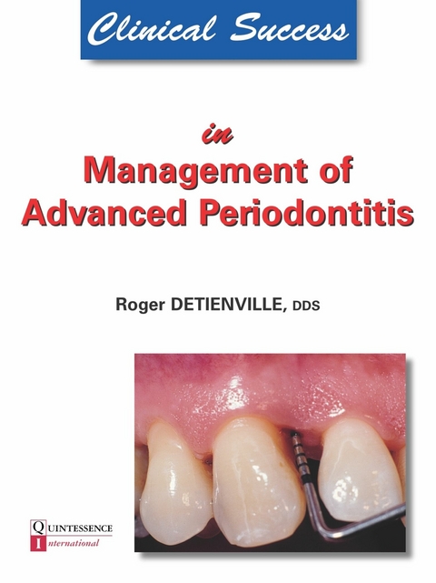 Clinical Success in Management of Advanced Periodontitis - Roger Detienville