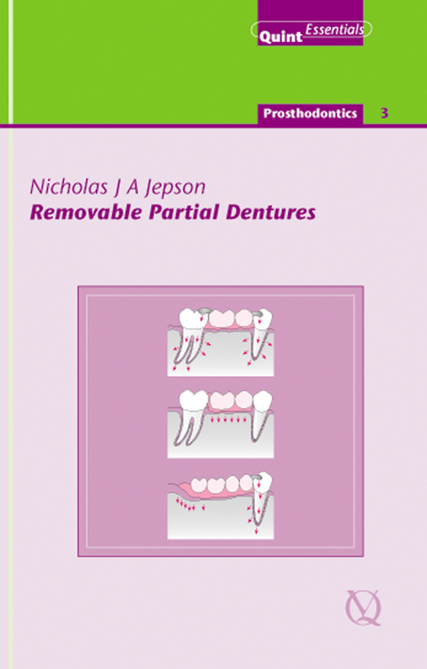 Removable Partial Dentures - Nicholas J. A. Jepson