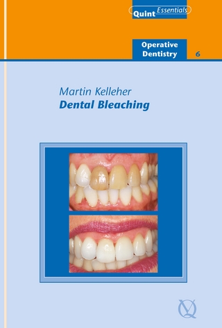 Dental Bleaching