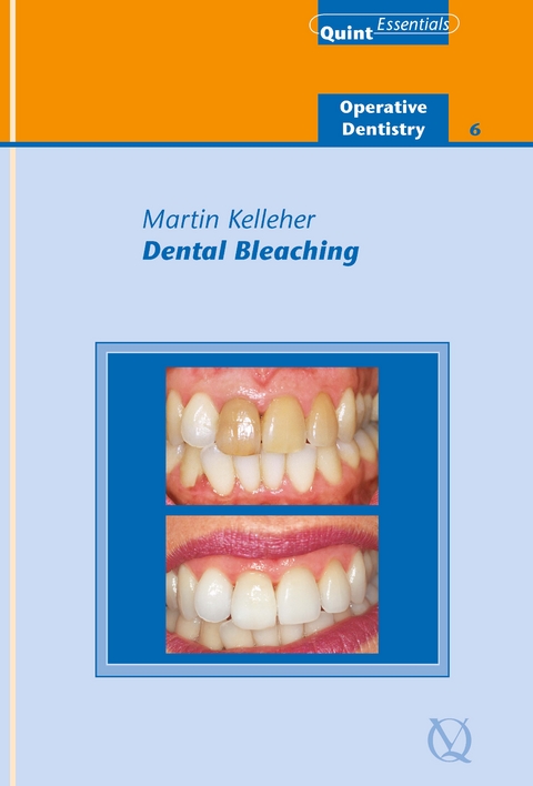 Dental Bleaching - Martin Kelleher