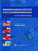 Membrangesch&uuml;tzte Knochenregeneration in der Implantologie - Daniel Buser