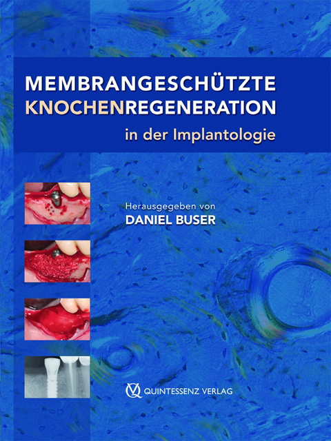 Membrangesch&uuml;tzte Knochenregeneration in der Implantologie - Daniel Buser