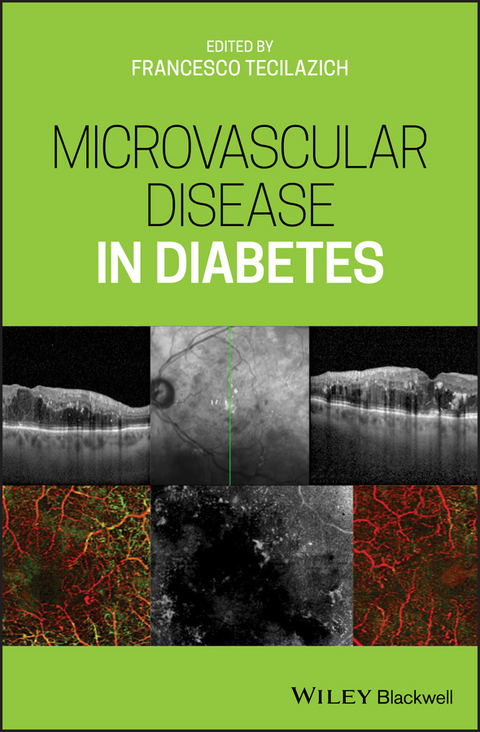 Microvascular Disease in Diabetes - 