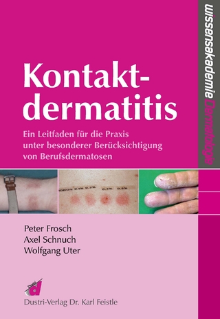 Kontaktdermatitis