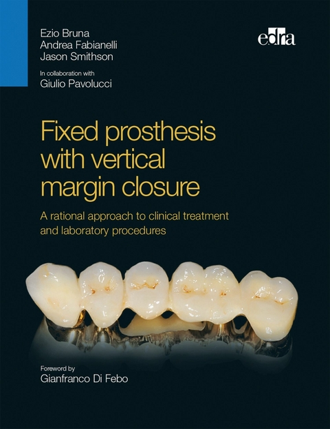 Fixed prosthesis with vertical margin closure -  Ezio Bruna