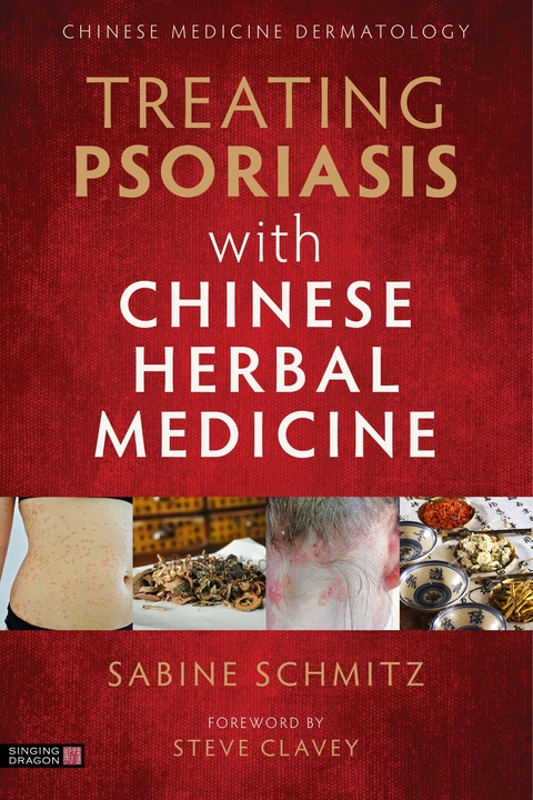 Treating Psoriasis with Chinese Herbal Medicine (Revised Edition) - Sabine Schmitz
