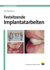Festsitzende Implantatarbeiten - Axel M&uuml;hlh&auml;user