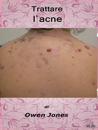 Trattare L''Acne