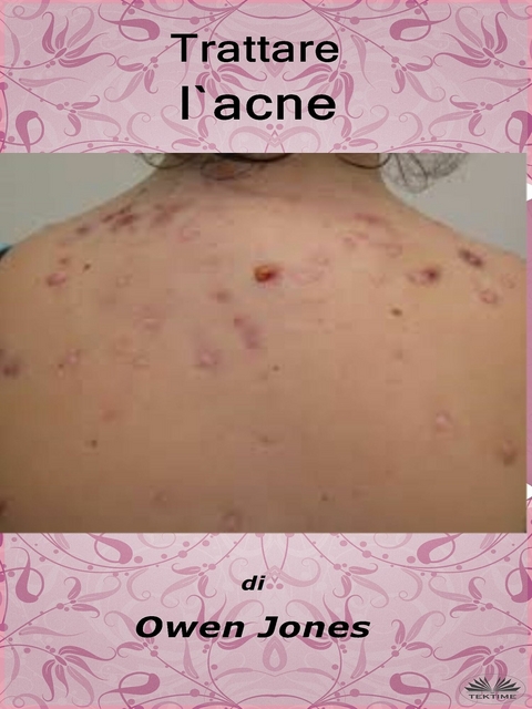 Trattare L''Acne -  Owen Jones