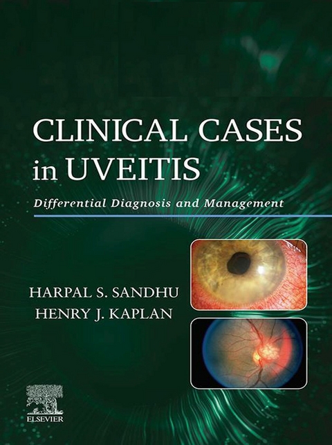 Clinical Cases in Uveitis E-Book - 