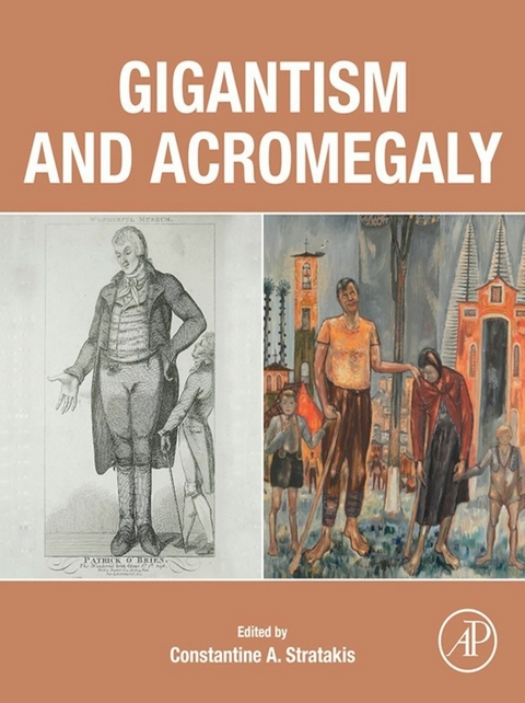 Gigantism and Acromegaly - 