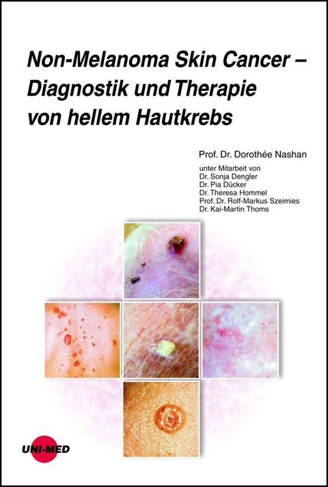 Non-Melanoma Skin Cancer - Diagnostik und Therapie von hellem Hautkrebs - Doroth&eacute;e Nashan