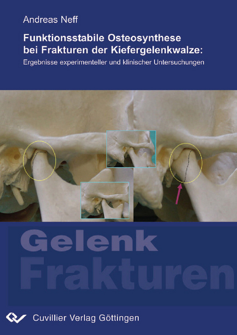 Funktionsstabile Osteosynthese bei Frakturen der Kiefergelenkwalze -  Andreas Neff