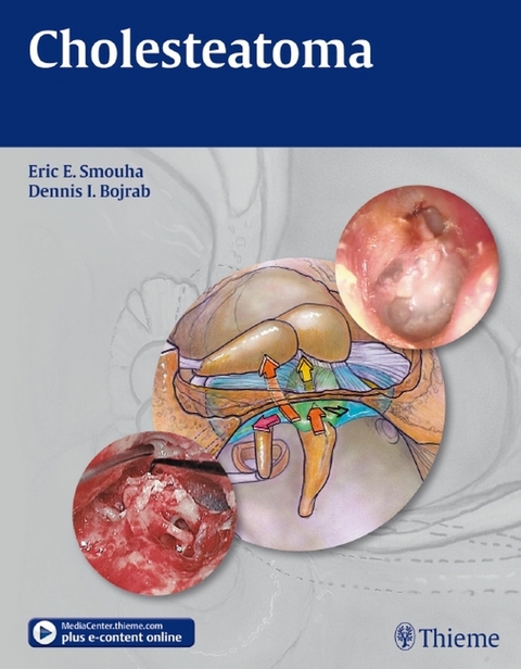 Cholesteatoma -  Eric E. Smouha,  Dennis I. Bojrab