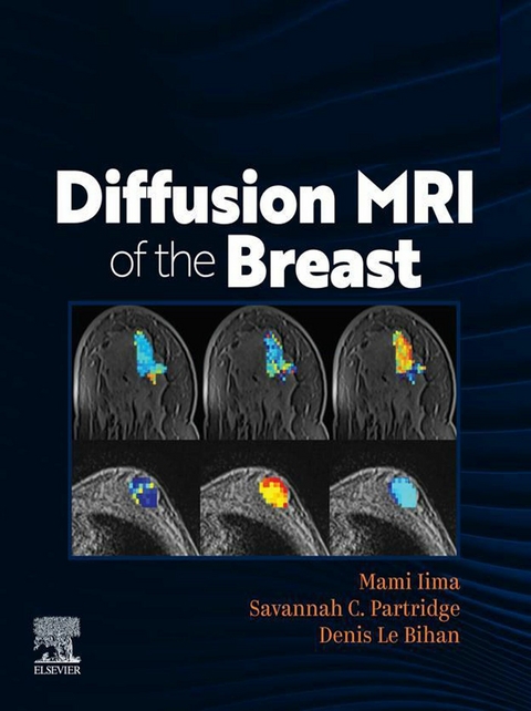 DIFFUSION MRI OF THE BREAST, E-Book - 