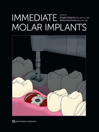 Immediate Molar Implants