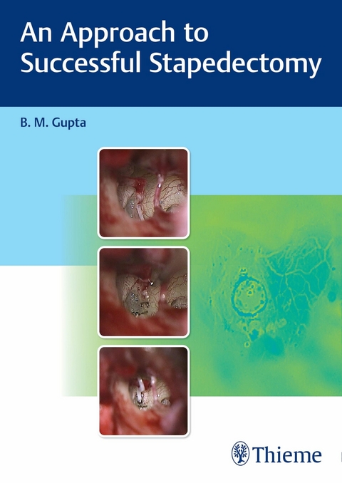 An Approach to Successful Stapedectomy - B. M. Gupta