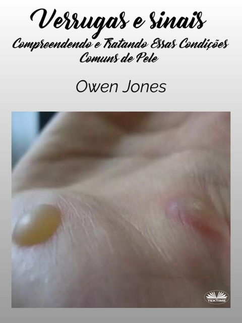 Verrugas E Sinais -  Owen Jones
