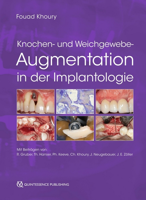 Knochen- und Weichgewebeaugmentation in der Implantologie - 